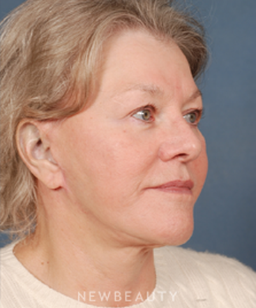 dr-bradley-calobrace-facelift-b