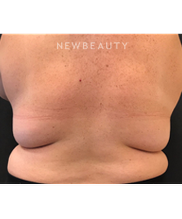 dr-janet-allenby-coolsculpting-b