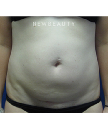 dr-niki-christopoulos-tummy-tuck-b