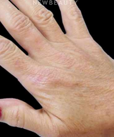 dr-kenneth-r-beer-hand-rejuvenation-b
