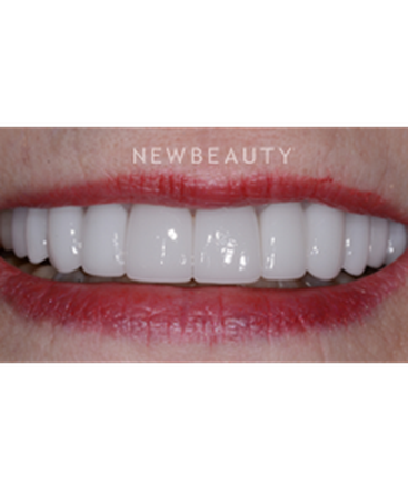 dr-guy-lewis-smile-makeover-b