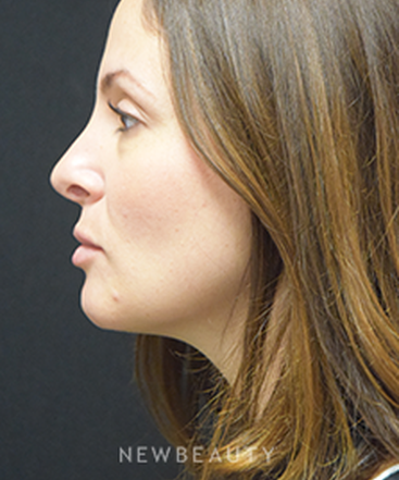 dr-jeffrey-b-wise-rhinoplasty-b