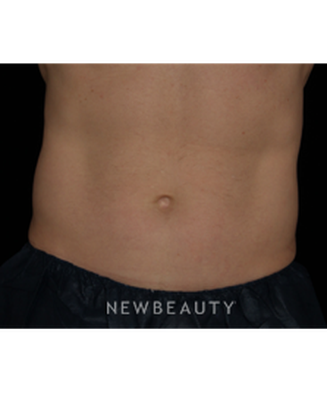 dr-jennifer-segal-coolsculpting-b