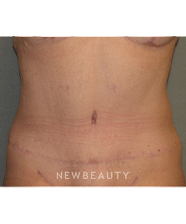 dr-sean-simon-tummy-tuck-lipo-b
