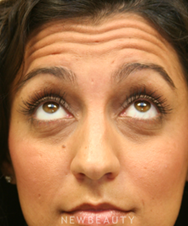 dr-jennifer-levine-botox-b