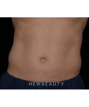 dr-jennifer-segal-coolsculpting-b