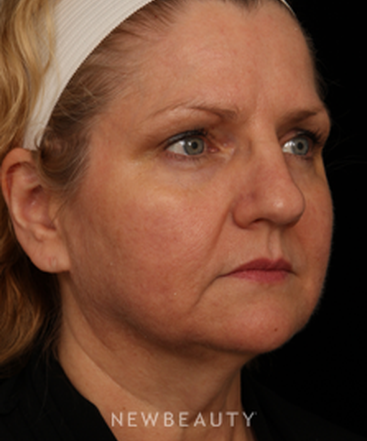 dr-jennifer-m-segal-facial-rejuvenation-b