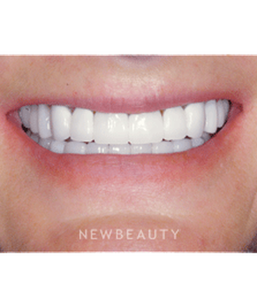 dr-guy-m-lewis-smile-makeover-b