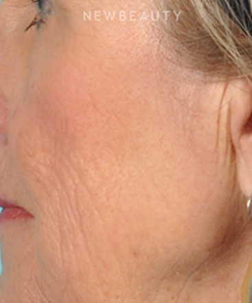 dr-bradley-bengtson-skin-rejuvenation-b
