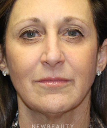 dr-dilip-madnani-facelift-b
