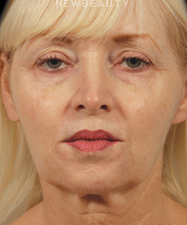 dr-kenneth-beer-liquid-facelift-b