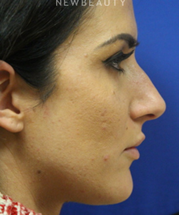 dr-jennifer-levine-rhinoplasty-b