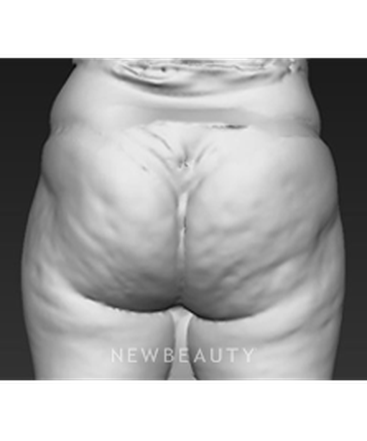 dr-brad-bengtson-cellulite-treatment-b