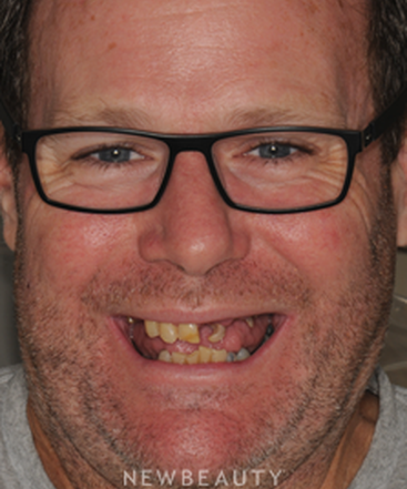 dr-maurice-salama-one-day-full-mouth-restoration-b
