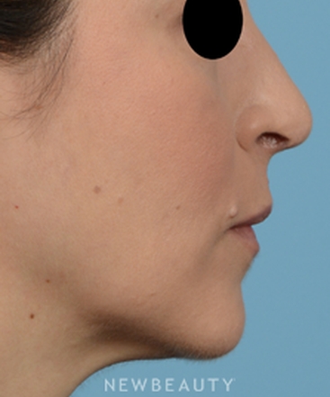 dr-jeffrey-b-wise-rhinoplasty-b