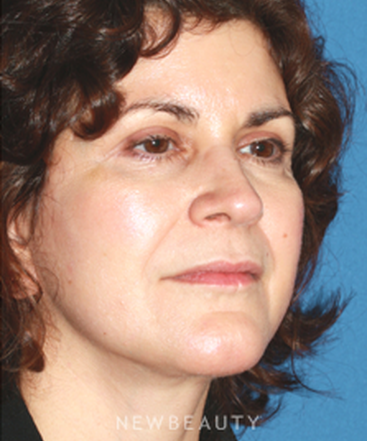 dr-konstantin-vasyukevich-traditional-facelift-b