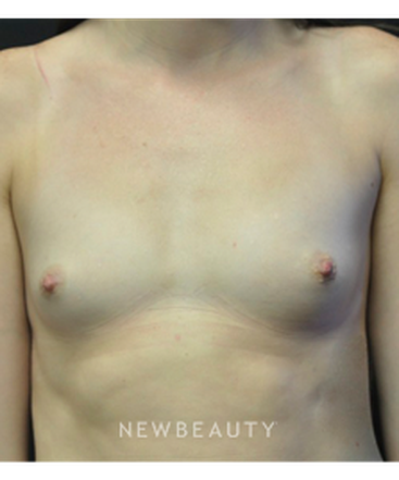 dr-andrew-smith-breast-augmentation-b