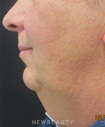 dr-kim-nichols-kybella-b