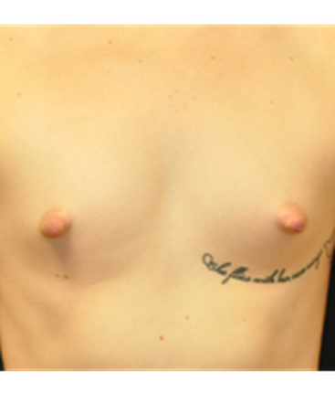 dr-andrew-smith-breast-augmentation-b