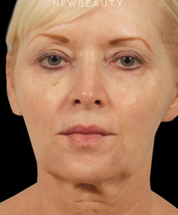 dr-kenneth-beer-liquid-facelift-b