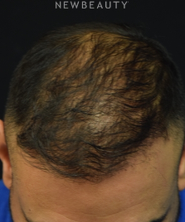 dr-jeffrey-b-wise-hair-transplant-for-hair-loss-b