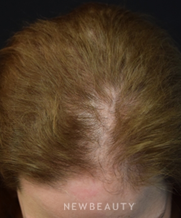 dr-jeffrey-b-wise-female-hair-loss-b