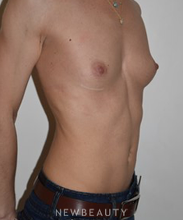 dr-david-p-rapaport-breast-augmentation-b
