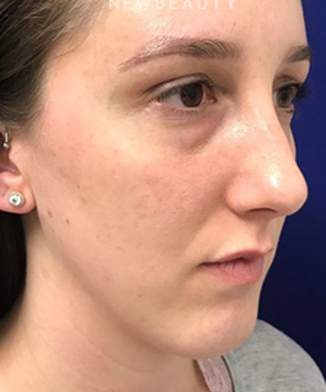 dr-dilip-madnani-lower-blepharoplasty-b