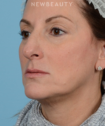 dr-jeffrey-wise-rhinoplasty-b