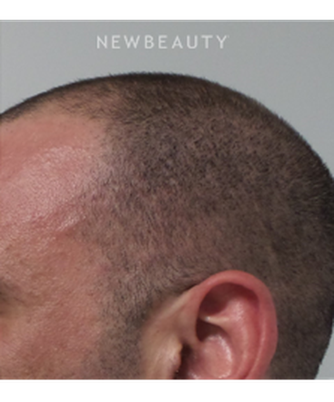 dr-marina-peredo-hair-loss-treatment-b