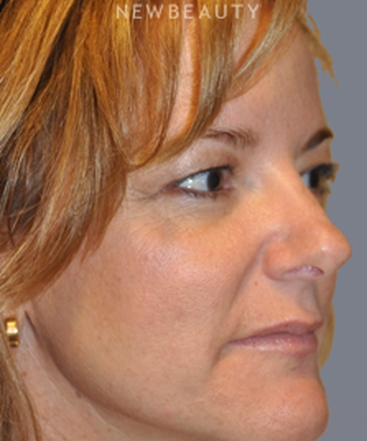 dr-bryan-w-gawley-revision-rhinoplasty-b
