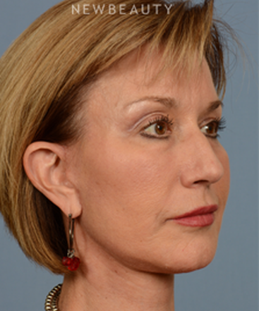 dr-bryan-w-gawley-facial-rejuvenation-b
