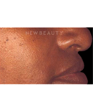 dr-charles-crutchfield-injectable-fillers-b