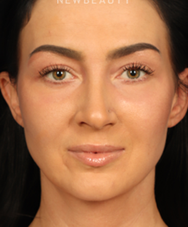 dr-raman-mahabir-lower-eyelid-b