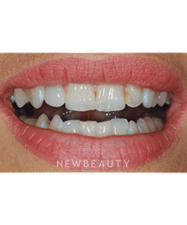 dr-ronald-goldstein-smile-makeover-invisalign-crowns-whitening-veneers-b