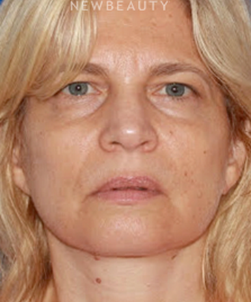 dr-konstantin-vasyukevich-upper-and-lower-blepharoplasties-b