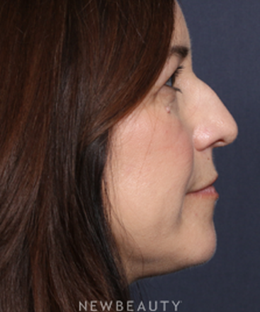 la-jolla-cosmetic-surgery-rhinoplasty-b