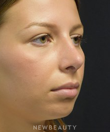 dr-jeffrey-b-wise-rhinoplasty-b