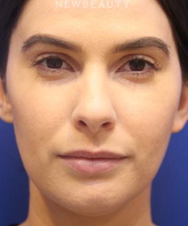 dr-jennifer-levine-lasers-b