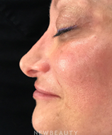 dr-jeffrey-wise-nonsurgical-rhinoplasty-b