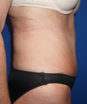 dr-niki-christopoulos-tummy-tuck-b