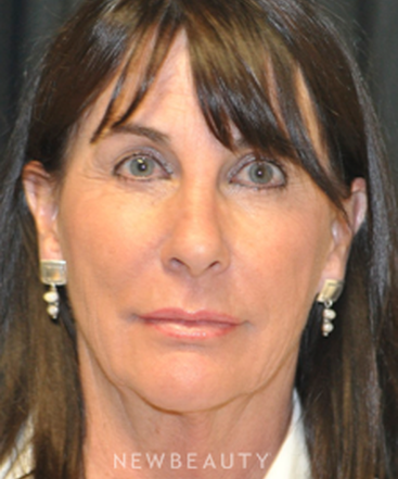 dr-andrew-smith-facelift-b