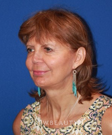 dr-dilip-madnani-facelift-b