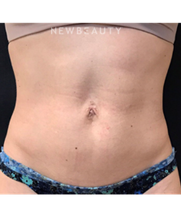 dr-janet-allenby-emsculpt-b