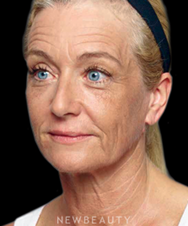 dr-kenneth-beer-liquid-facelift-b