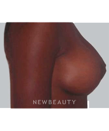 dr-michael-horn-breast-lift-b