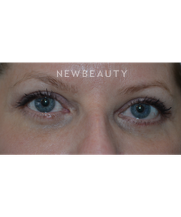dr-baljeet-k-purewal-blepharoplasties-b