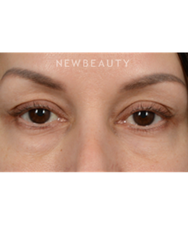dr-jeffrey-wise-lower-blepharoplasty-b