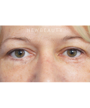 dr-raymond-douglas-lower-blepharoplasty-b