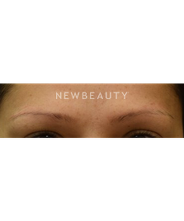 dr-jeffrey-b-wise-eyebrow-hair-restoration-b